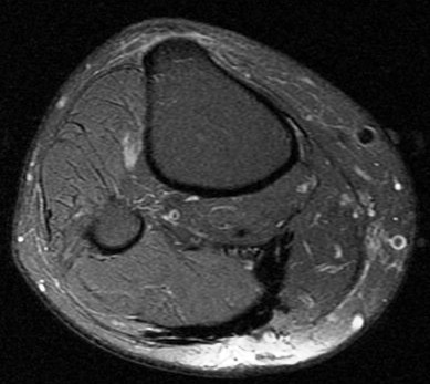 Figure 5 for case aggressive fibromatosis ( RID4292 )